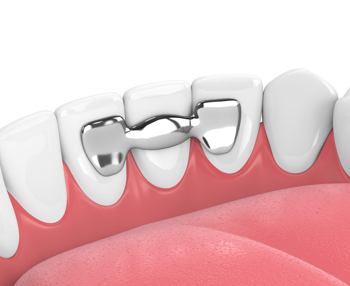 Three Alternatives to a Traditional Dental Bridge - Binder Family Dental