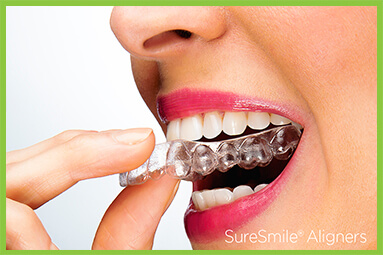 close up of mouth putting on Invisible Clear Aligners