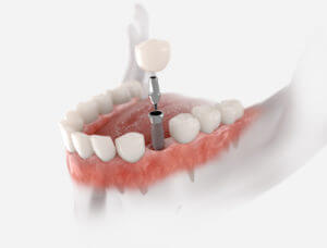 Dental implant Image