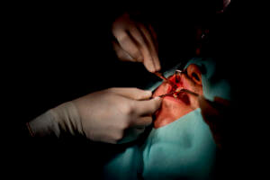 Dental Implant surgery ongoing by dentist