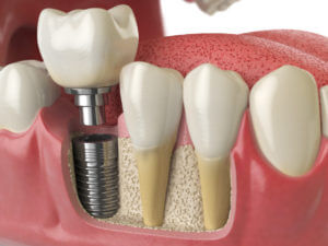 tooth dental implant