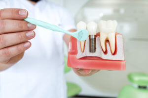 Male Dentist Explaining Dental Implantation