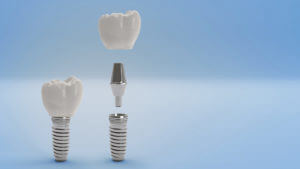 Teeth Implant
