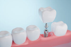 Denture implant peocedure