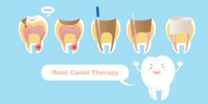 Root Canal Therapy