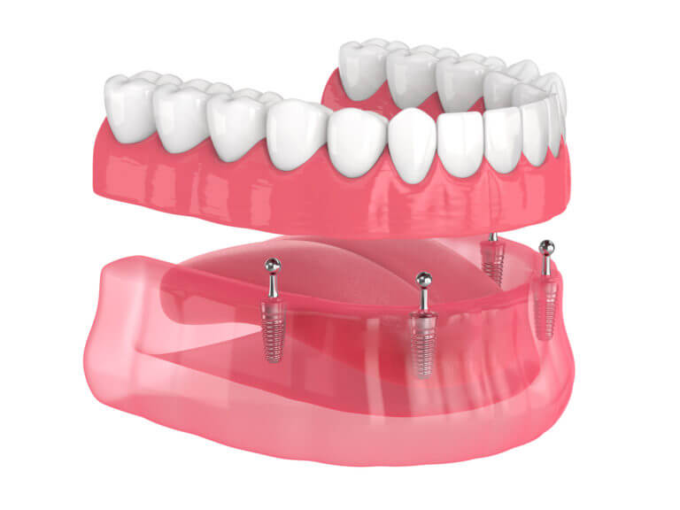 implants supported overdenture installation