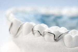orthodontic brace for tooth straightening