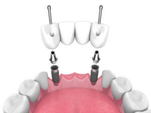 3d render of jaw with dental bridge supported by implants over white background