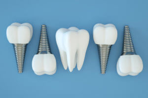 Tooth Implant, Artificial Teeth, Dental Implantation