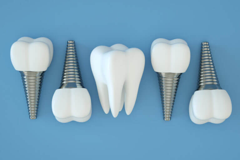 Tooth Implant, Artificial Teeth, Dental Implantation