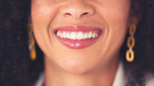 woman shows her teeth after zoom teeth whitening