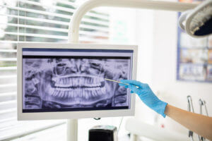 Image of X-ray for patient receiving dental care.