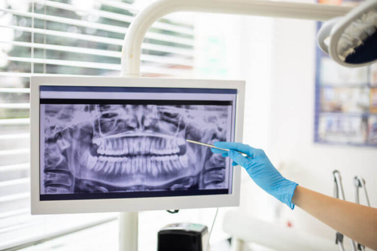 Image of X-ray for patient receiving dental care.
