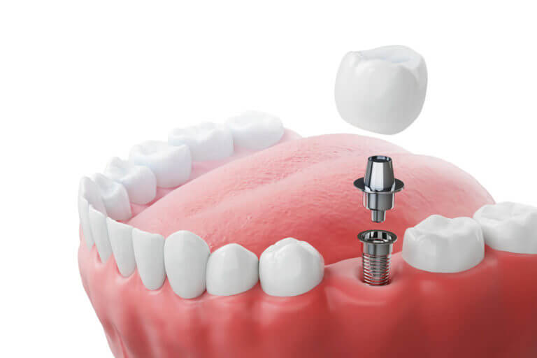 A 3D illustration of teeth with an implant screw to illustrate Dental implants.