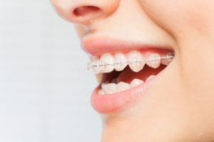 Teen girl wearing clear braces.