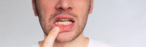 Close-up image of a man's gums showing signs of inflammation, indicating a possible gum disease.