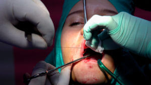 The dentist stitched the wound after the oral cyst removal during an emergency dental care procedure.
