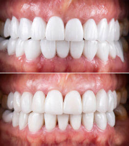 An image showcasing dental photography of ceramic crowns and veneers used in dental work.