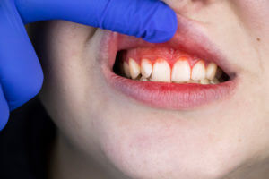 Close-up image of a man being examined by a dentist for gingivitis, a gum disease causing bleeding and inflammation.