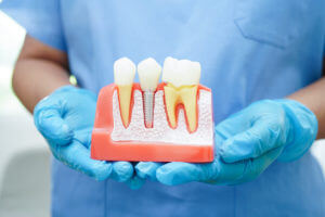 A dentist wearing gloves is holding a dental implant, which are artificial tooth roots used in root canal treatment.