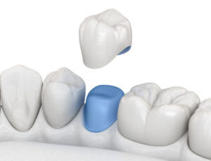 A 3D illustration of a porcelain dental crown placement over a premolar tooth.
