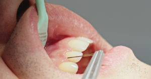 An extreme close-up of a dentist using an electronic periodontal probe on a patient with gum disease.