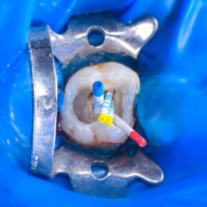 Image of upper first collar root canal treatment.