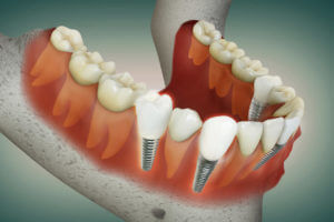 A 3D illustration of Multiple Dental implant.