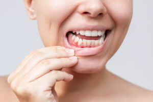 A red lump on the gum near the tooth of a woman with gum disease.