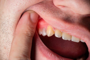 Close-up of a man’s mouth showing red, swollen gums with visible signs of inflammation and irritation, consistent with gingivitis and gum infection (possible abscessflux).