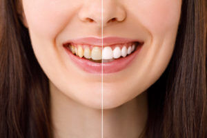 Smiling woman before and after her dental teeth whitening procedure.