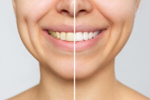Cropped shot of a young smiling woman before and after teeth whitening.