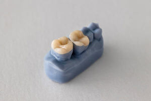 Tooth model with inlays and onlays for dental restoration